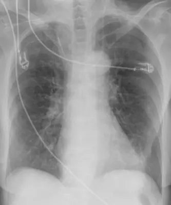 Radiograph from the case bank: Central venous catheter
