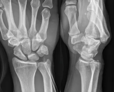 Radiograph from the case bank: Carpal or carpometacarpal dislocation