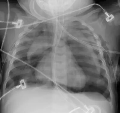 Radiograph from the case bank: Pneumomediastinum