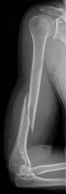 Radiograph from the case bank: Humeral shaft fracture