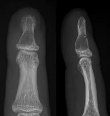 Radiograph from the case bank: Enchondroma