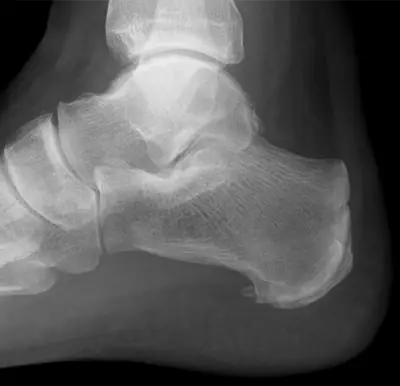 Radiograph from the case bank: Calcaneal spur