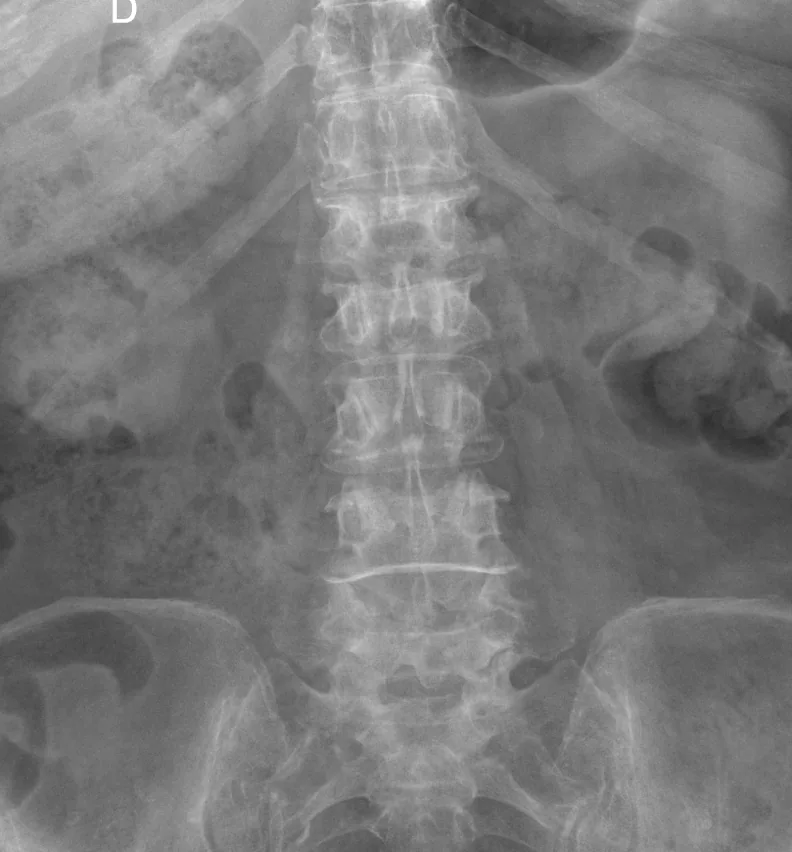 Spine radiograph for self-assessment