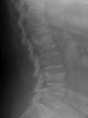 Radiograph from the case bank: Lumbar vertebral fracture