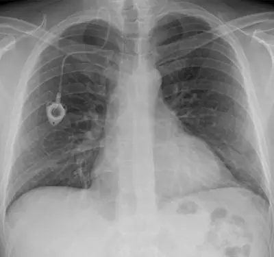 Radiograph from the case bank: Implanted venous access port (port-a-cath)