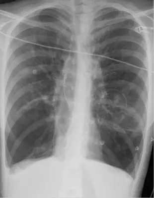 Radiograph from the case bank: Emphysema / COPD (hyperinflation)