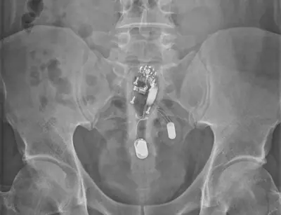 Radiograph from the case bank: Foreign body (ingested or inserted)