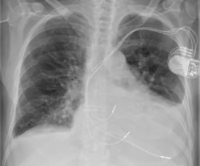 Radiograph from the case bank: Cardiac pacemaker