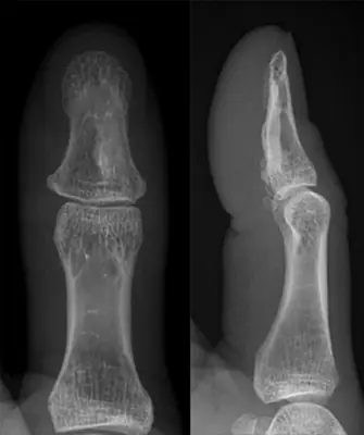 Radiograph from the case bank: Osteoma