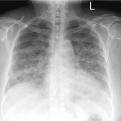 Radiograph from the case bank: Pulmonary oedema (heart failure)