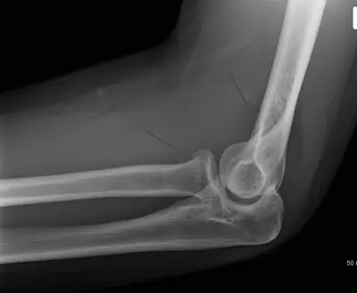 Radiograph from the case bank: Radial head fracture