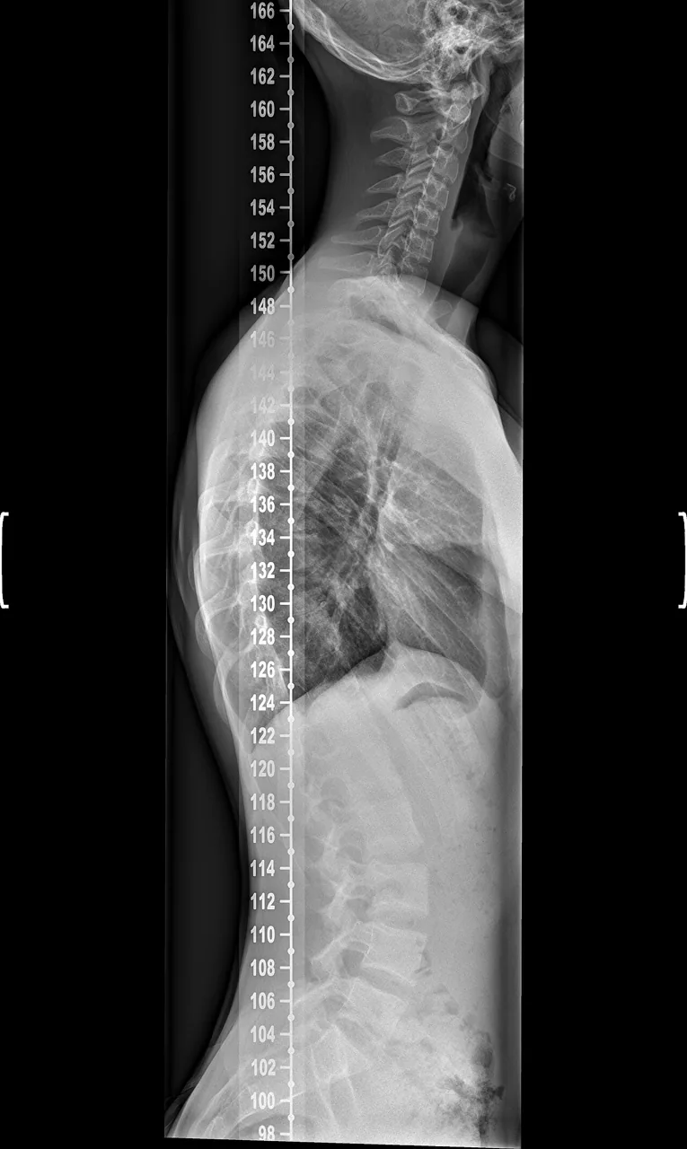 Spine radiograph for self-assessment