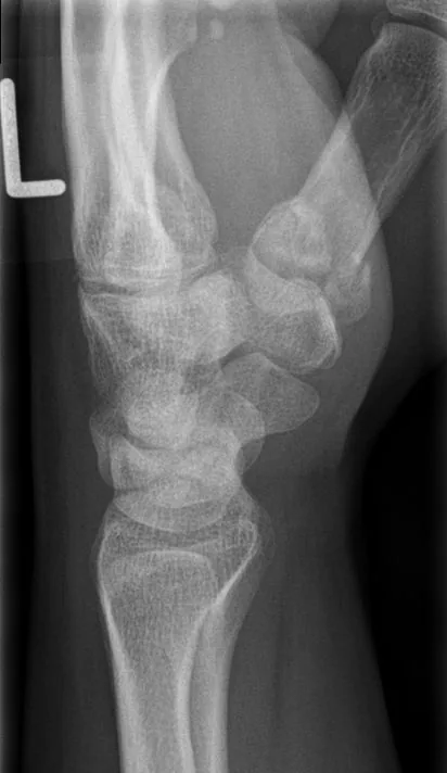 Upper limb radiograph for self-assessment