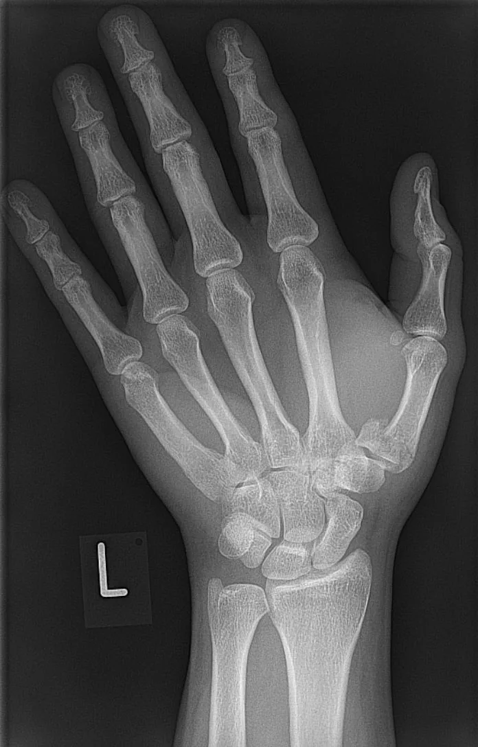 Upper limb radiograph for self-assessment