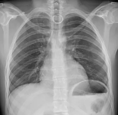 Radiograph from the case bank: Foreign body in the oesophagus