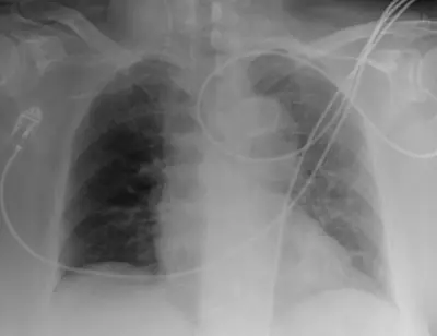 Radiograph from the case bank: Central venous catheter