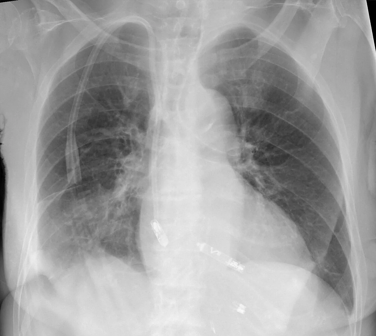 Lines & tubes radiograph for self-assessment