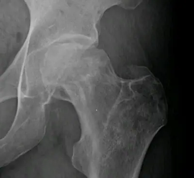 Radiograph from the case bank: Avascular necrosis of the femoral head