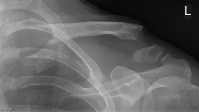 Radiograph from the case bank: Clavicle fracture