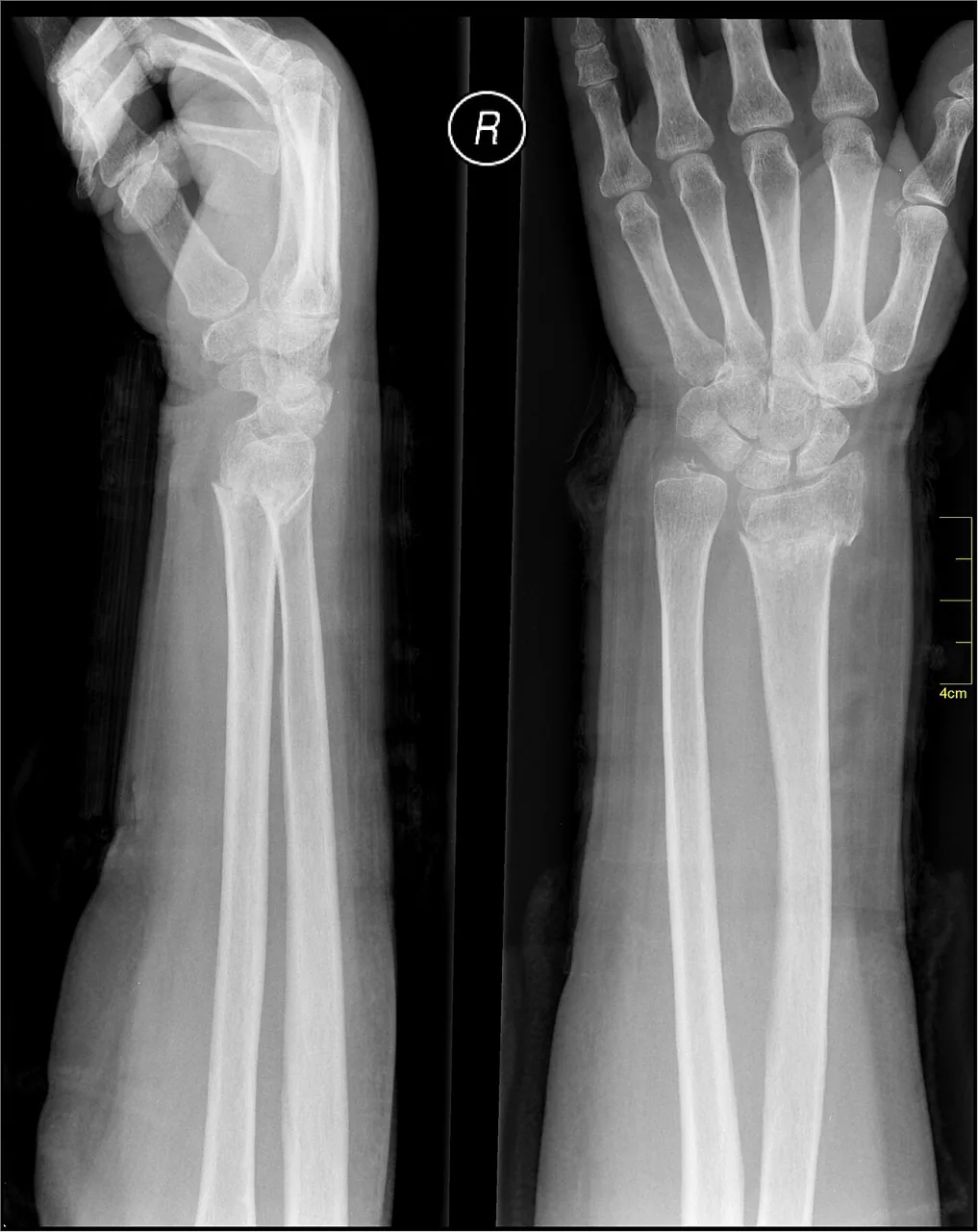 Upper limb radiograph for self-assessment