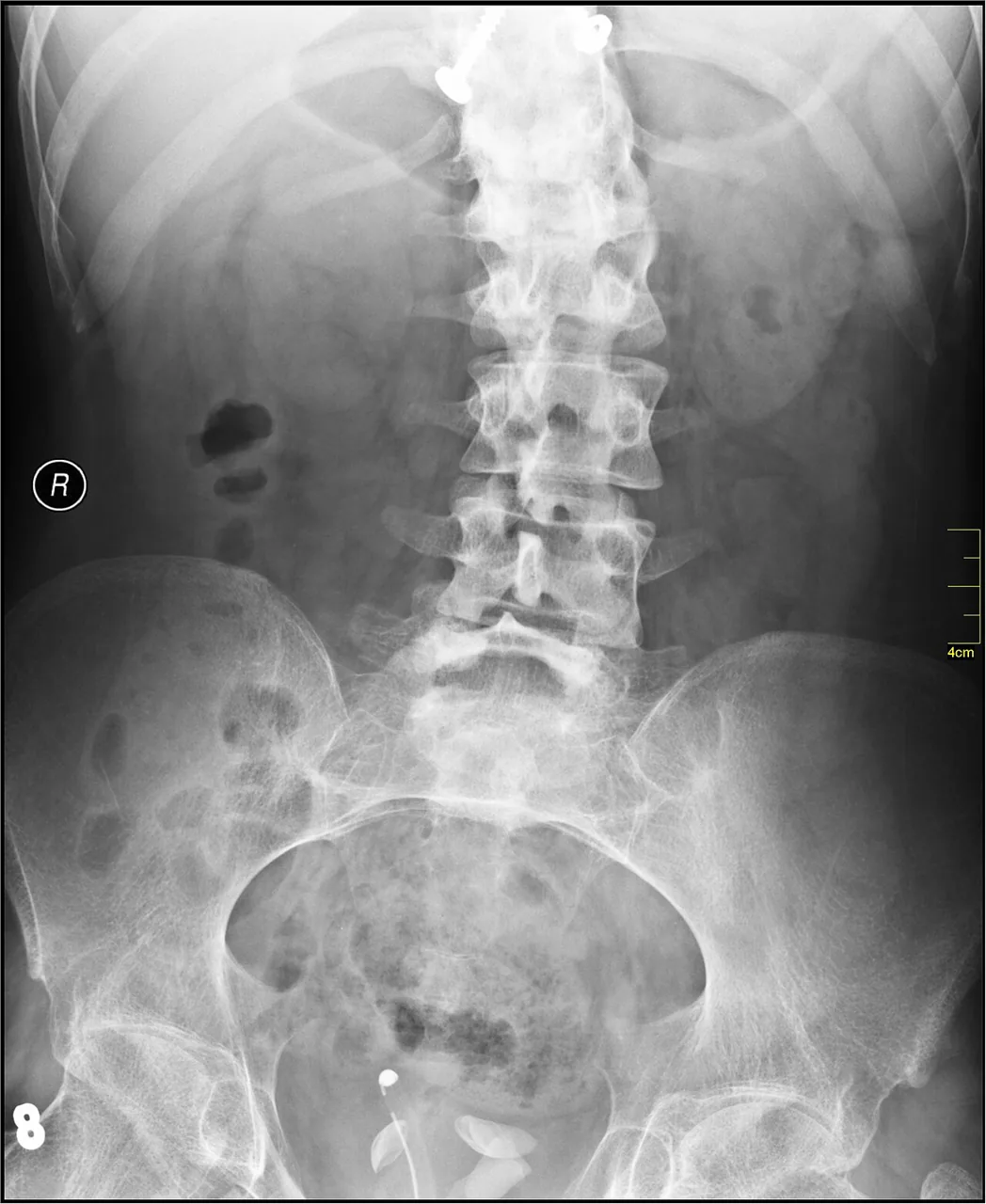 Spine radiograph for self-assessment