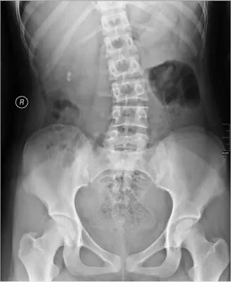Radiograph from the case bank: Urinary tract calculi (kidney or ureteric stones)