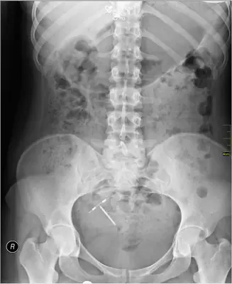 Radiograph from the case bank: Intrauterine contraceptive device (IUCD)