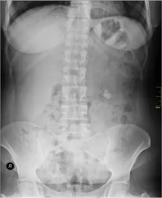 Radiograph from the case bank: Urinary tract calculi (kidney or ureteric stones)