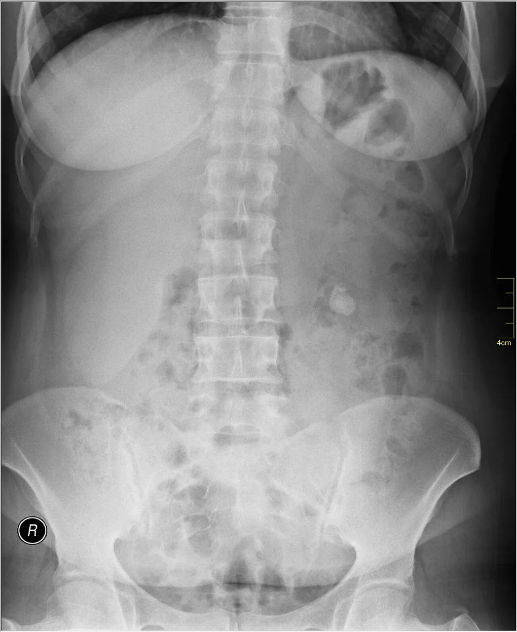 Abdomen radiograph for self-assessment