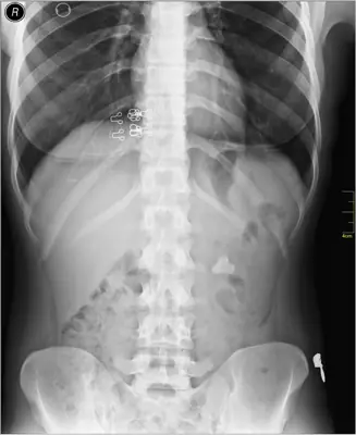 Radiograph from the case bank: Urinary tract calculi (kidney or ureteric stones)