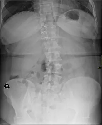 Radiograph from the case bank: Scoliosis