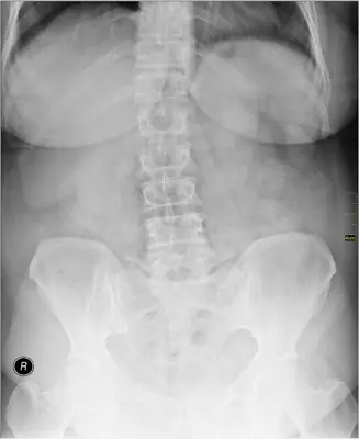 Radiograph from the case bank: Scoliosis