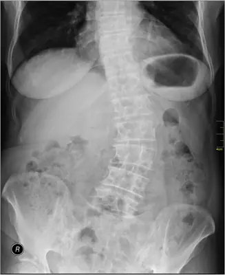 Radiograph from the case bank: Scoliosis