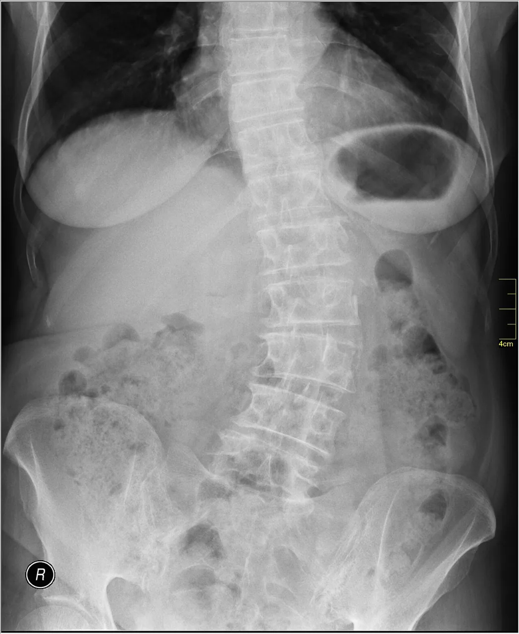 Spine radiograph for self-assessment