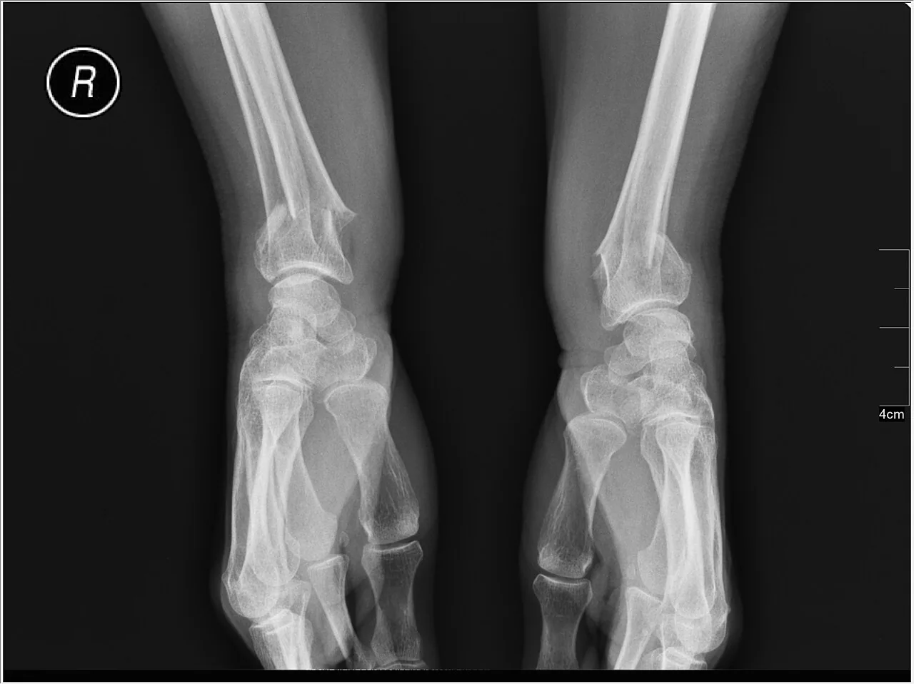 Upper limb radiograph for self-assessment