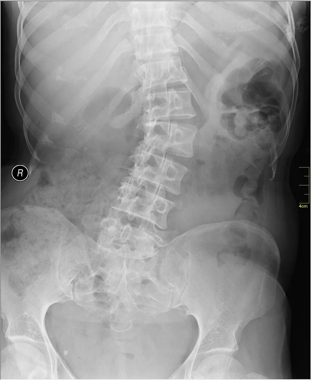 Spine radiograph for self-assessment