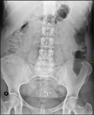 Radiograph from the case bank: Intrauterine contraceptive device (IUCD)