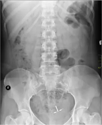 Radiograph from the case bank: Intrauterine contraceptive device (IUCD)
