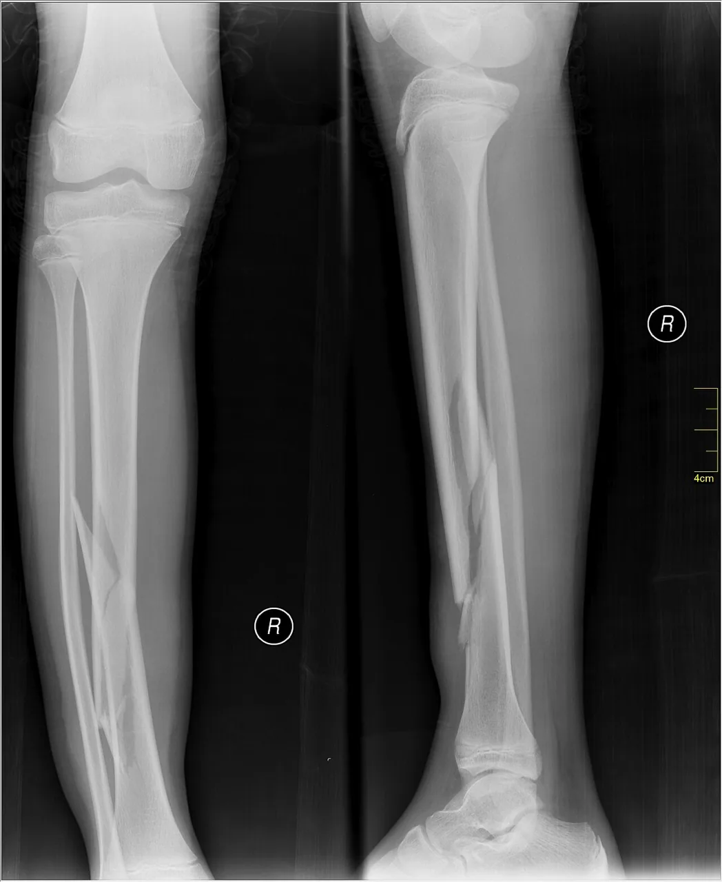Lower limb radiograph for self-assessment