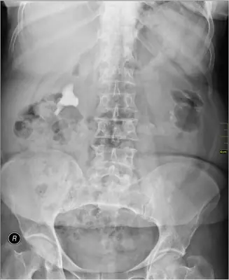 Radiograph from the case bank: Urinary tract calculi (kidney or ureteric stones)