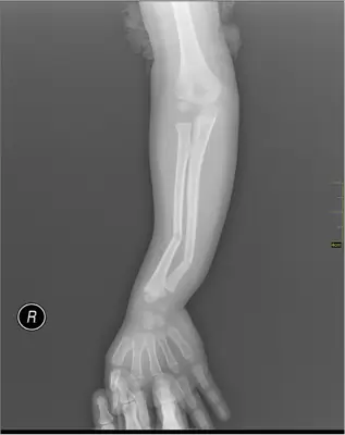 Radiograph from the case bank: Forearm shaft fracture (radius and ulna)