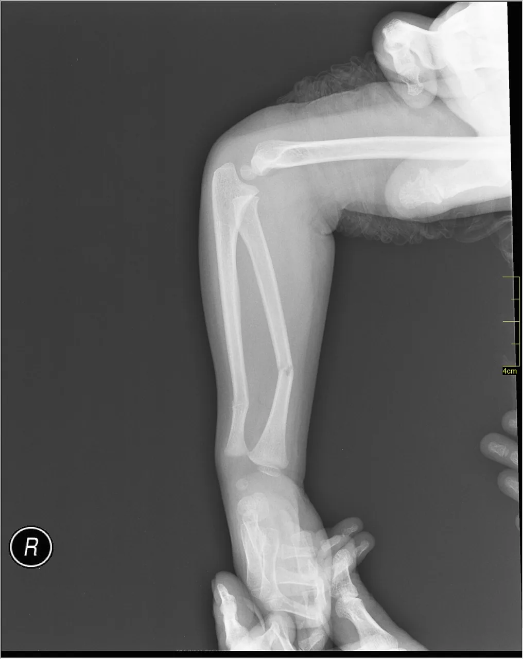 Upper limb radiograph for self-assessment