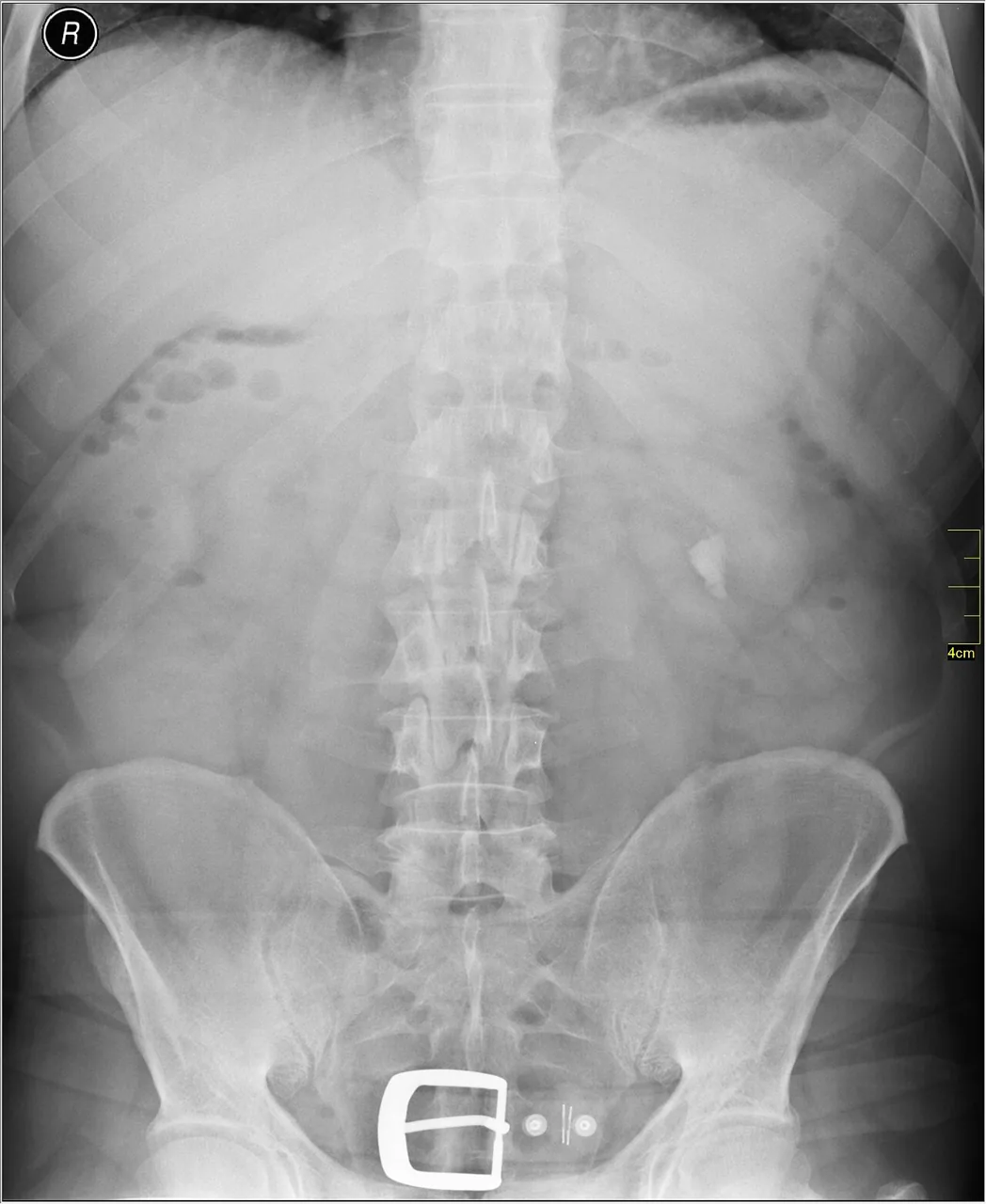 Abdomen radiograph for self-assessment