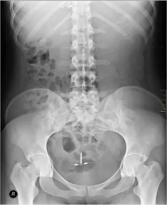 Radiograph from the case bank: Intrauterine contraceptive device (IUCD)