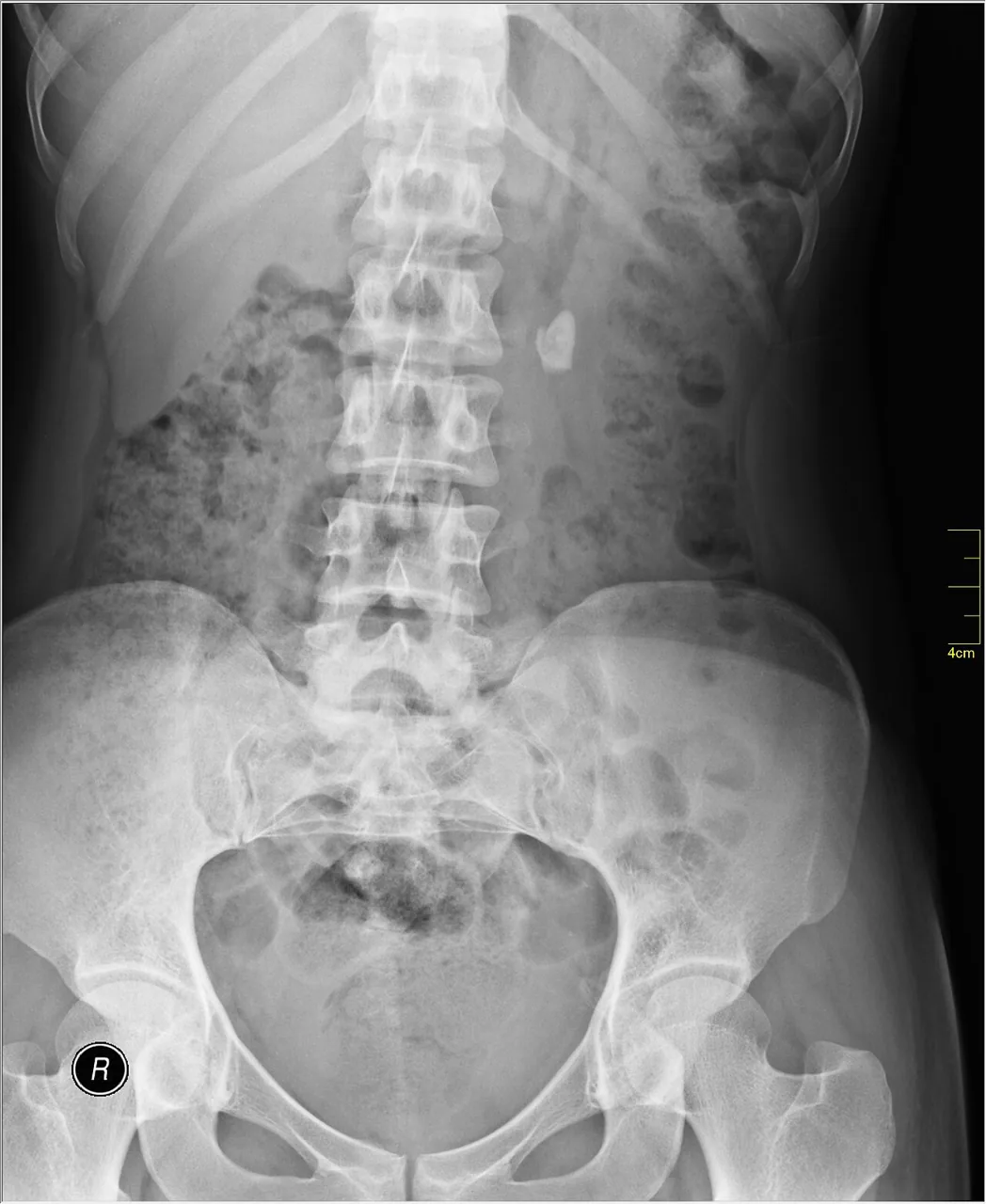 Abdomen radiograph for self-assessment