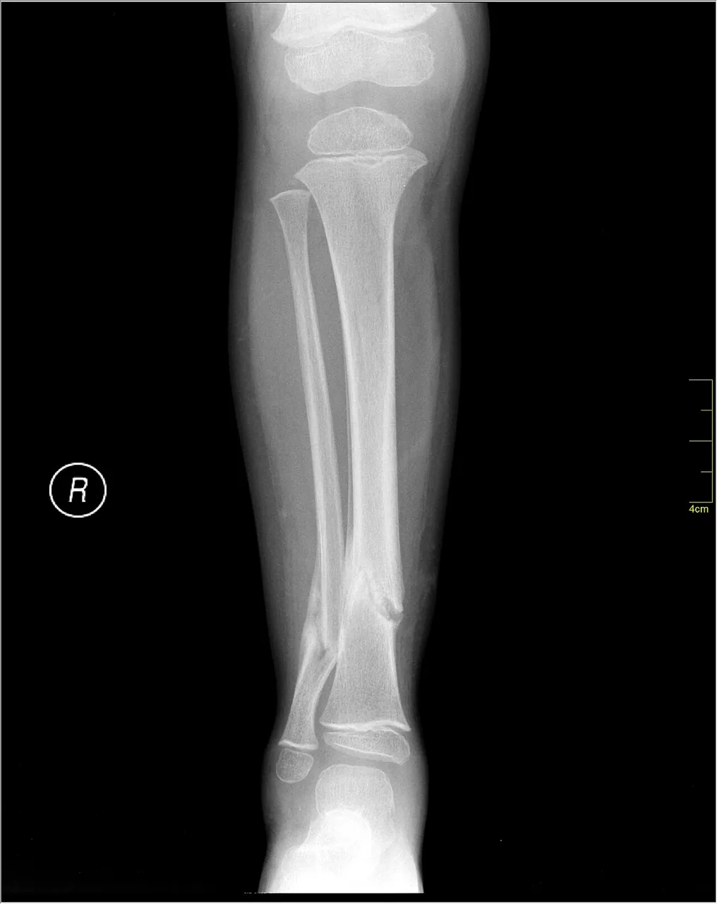 Lower limb radiograph for self-assessment