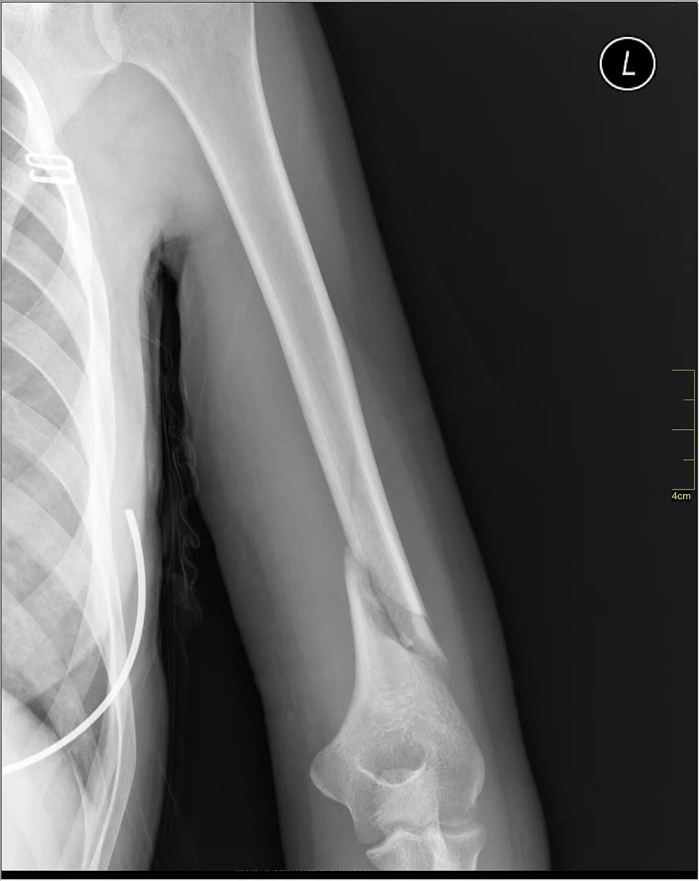 Upper limb radiograph for self-assessment