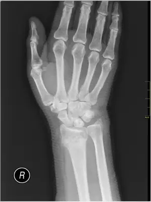 Radiograph from the case bank: Distal radius fracture