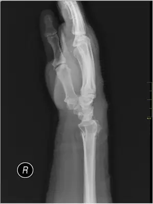 Radiograph from the case bank: Distal radius fracture
