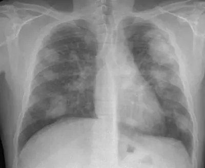 Radiograph from the case bank: Silicosis / pneumoconiosis